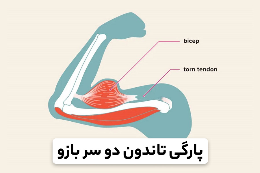 علل و درمان پارگی تاندون دوسر بازو در شانه چیست؟