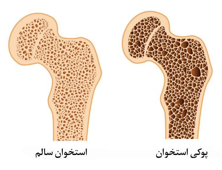 علائم و نشانه های پوکی استخوان